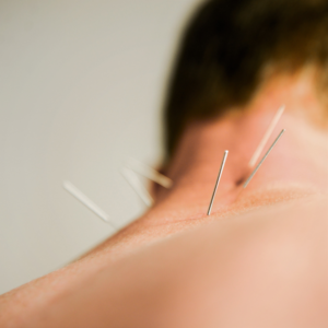 Close up of dry needles in the back of a man's neck.